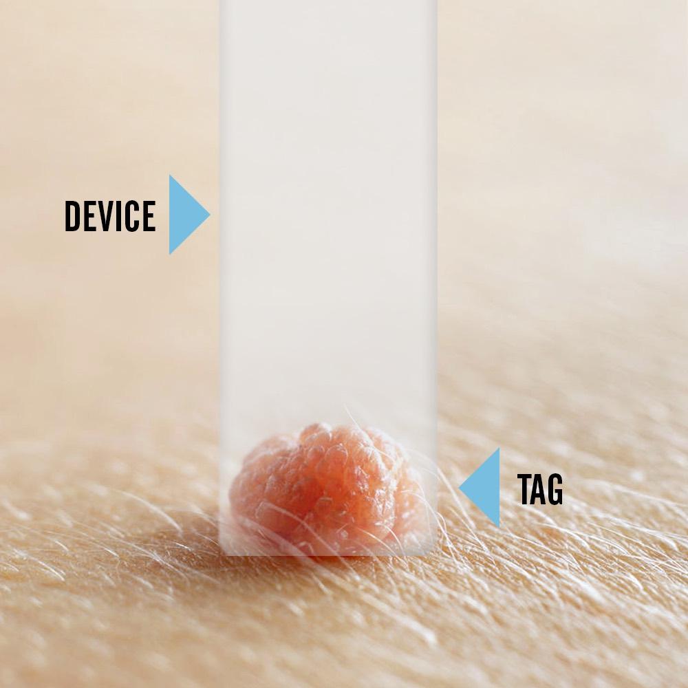 Tagcure - Skin Tag Removal Device - Version 2.0