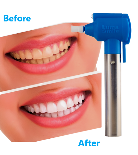 Luma Smile Teeth Whitening and Polishing Device