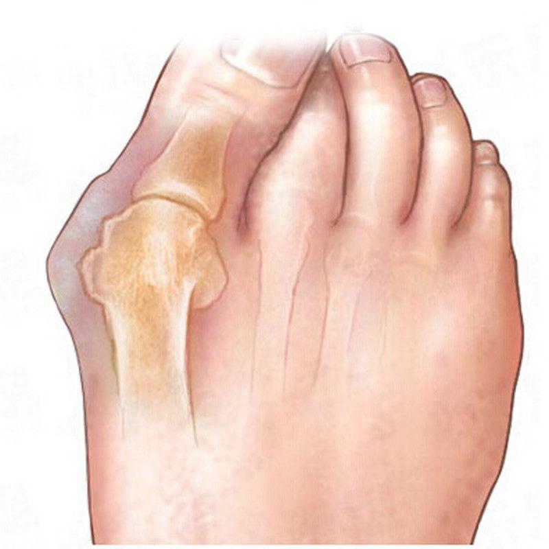 Generise Bunion Exerciser